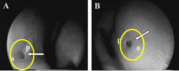人類費洛蒙接收器官-犁鼻器內視鏡圖